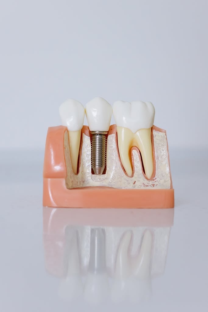 Close-Up Shot of Dental Implant Model